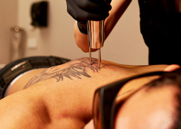 How Painful Is Tattoo Removal How Painful Is Tattoo Removal